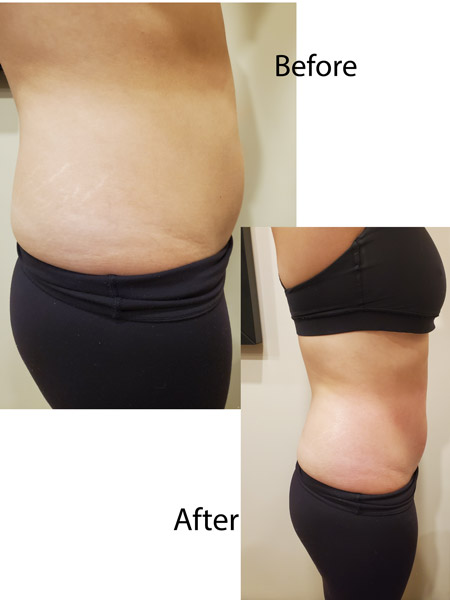 SharpLight Body Contouring - Results after 1st treatment