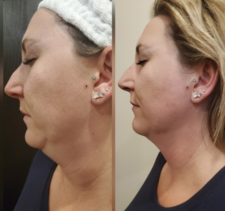 SharpLight Facial Contouring treatment showing results after 1 treatment on a woman's face