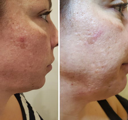 RF Photo Facial - Results after 1st Treatment