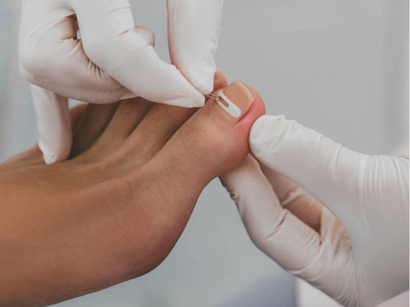 Ingrown Nail Treatment